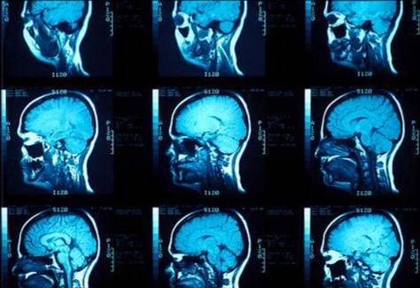 Magnetic
                  Resonance Imaging Brain-scans - can you tell which is
                  which?